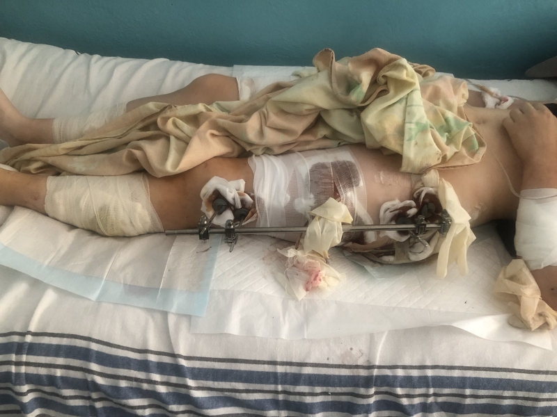 «Я бачила, як летів снаряд. Пам’ятаю цей страшний звук. Потім запаморочення, біль»: у Миколаєві рятують тяжкопоранену 20-річну студентку